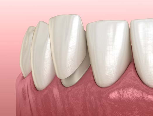 dental veneers 2602 Restore Your Smile With Dental Veneers