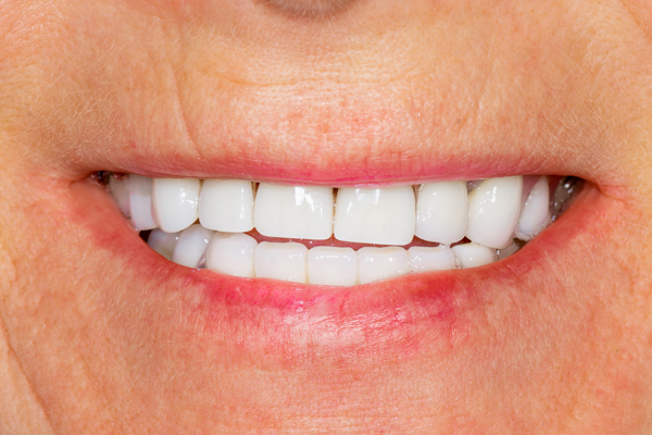 Cosmetic Dentistry Options With Dental Crowns