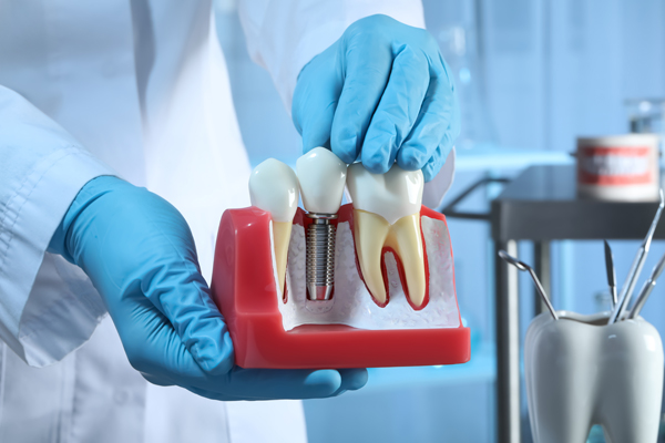 Caring For Your Dental Implants: Tips For Maintaining Oral Health