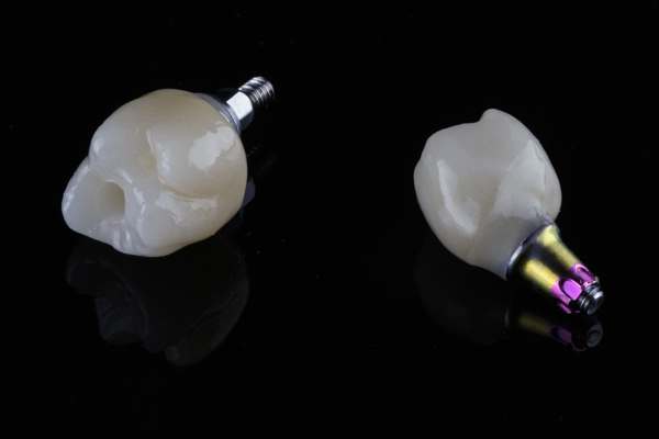 Reasons Why You Should Consider Getting Dental Implants